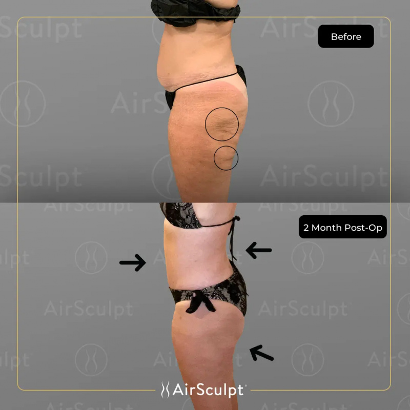 Vicki Gunvalson's before and after using AirSculpt