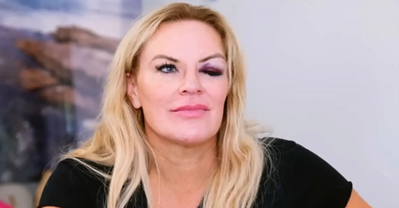  brezo gay's black eye on RHOSLC
