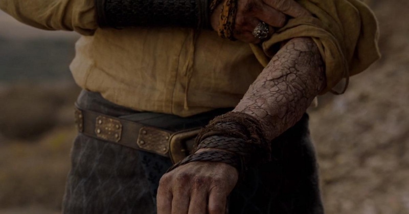 Jorah Mormont's greyscale in 'Game of Thrones.'