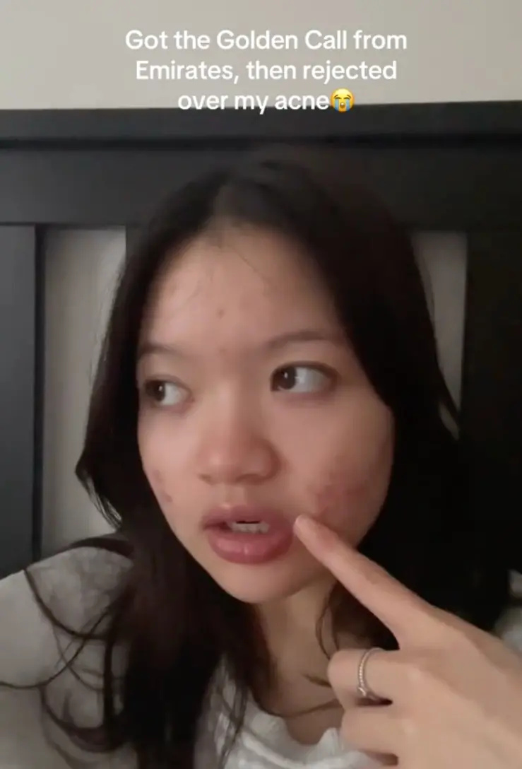 에미레이트 항공 승무원으로 채용됐다가 여드름 때문에 거절당했다고 주장하는 한 여성의 게시물이 화제입니다.